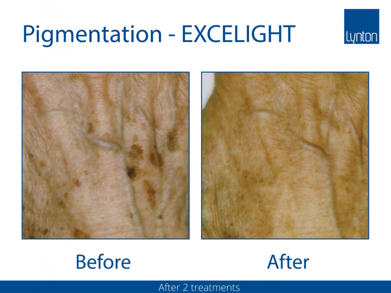 Pigmentation IPL Revive Skin and Laser