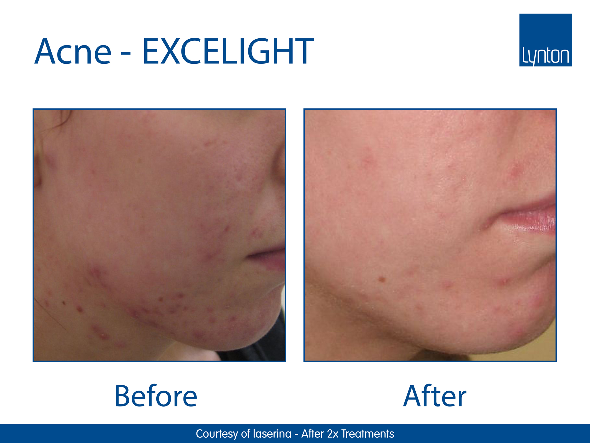 excelight-acnetreatment-reviveipl-worcesteripl-worcesterclinic.jpg