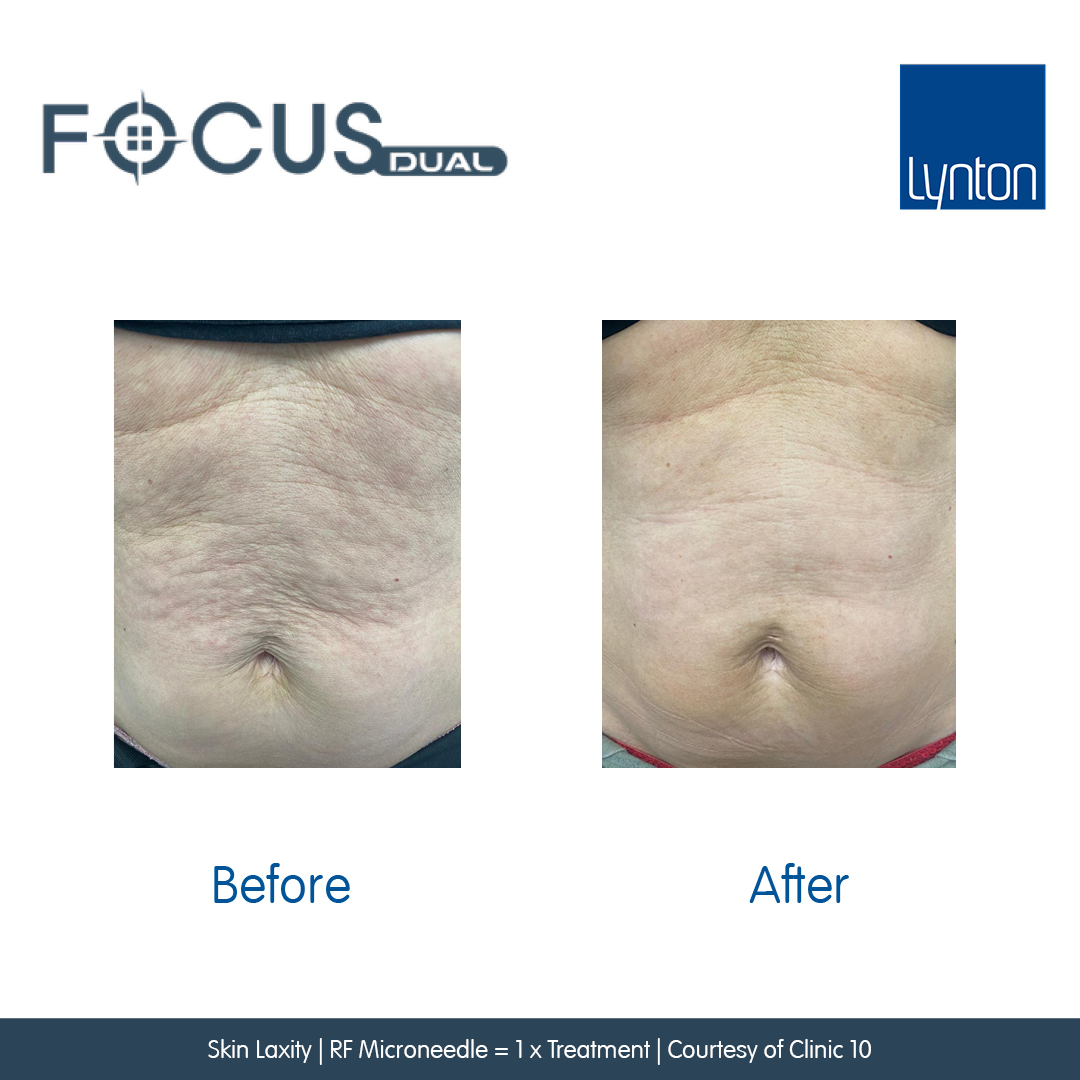 Before and After. Focus Dual. 7. Skin Laxity. RFM. Clinic 10 (1)