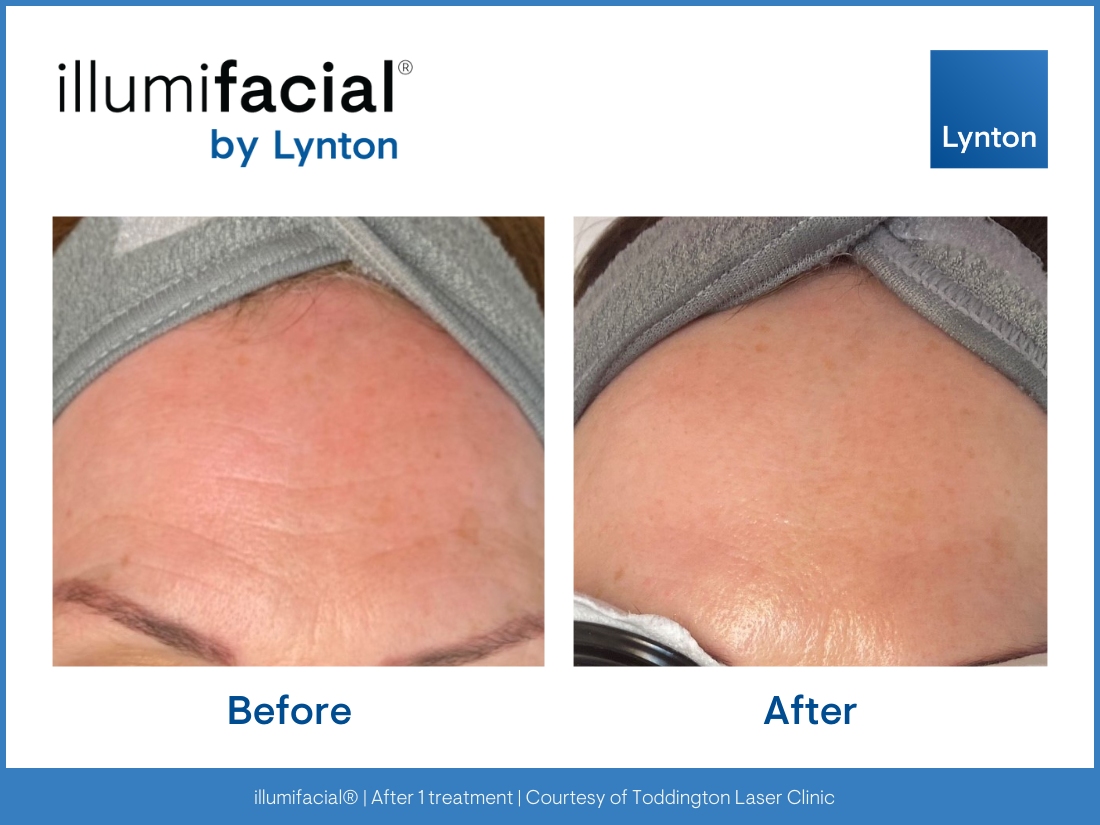 Before& After template- Illumifacial (2)