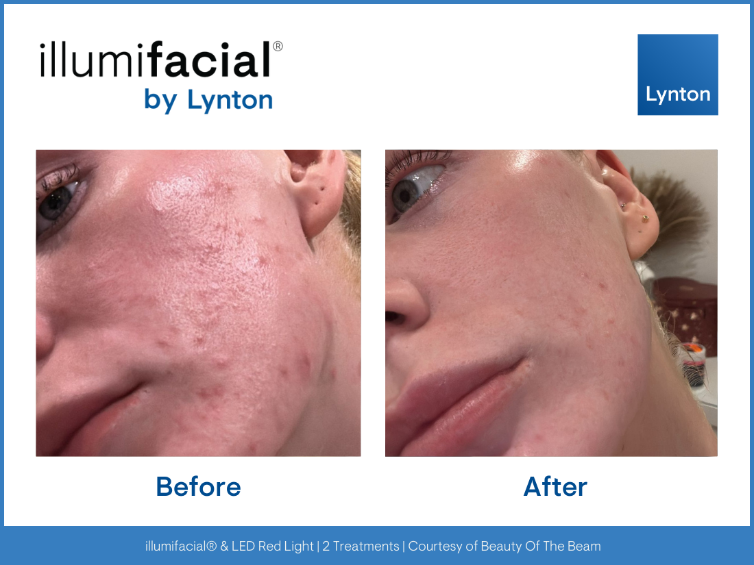 Before& After template- Illumifacial (6)