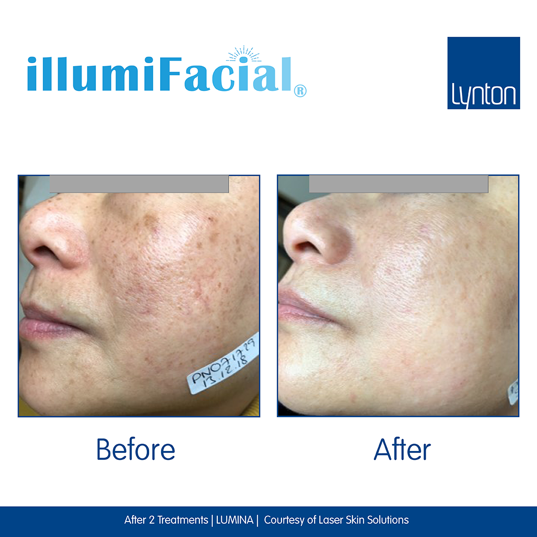 Before and After. illumiFacial. Lumina. Laser Skin Solutions