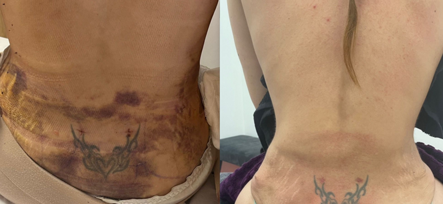 Blue--NIR--Red--10-Tri-Wave-MD-Treatments--1-2-per-week--Courtesy-of-Kate-Monteith-Ross