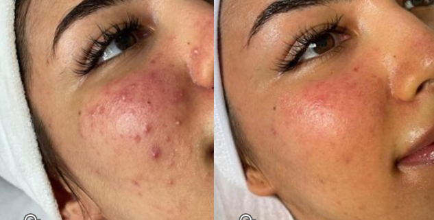 Blue--Red--NIR--10-Tri-Wave-MD-Treatments--15-Weeks--Courtesy-of-Homeira-Darbandi-Skincare--Tehran