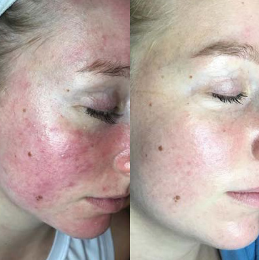 Blue--Red--NIR--10-Tri-Wave-MD-Treatments--3-Weeks--Courtesy-of-Clearskin-Huidinstituut--The-Netherlands