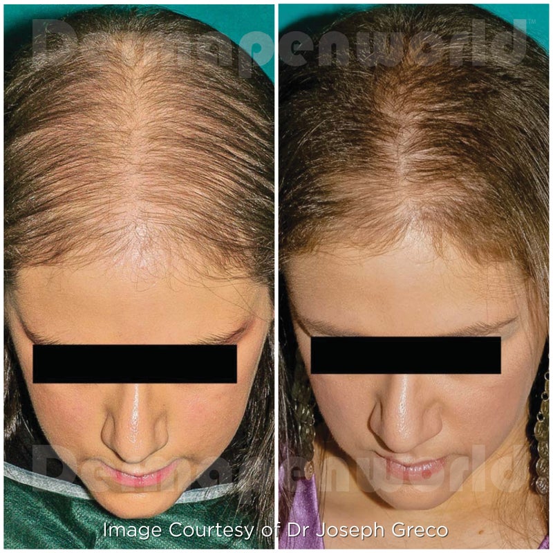 Hair restoration 1