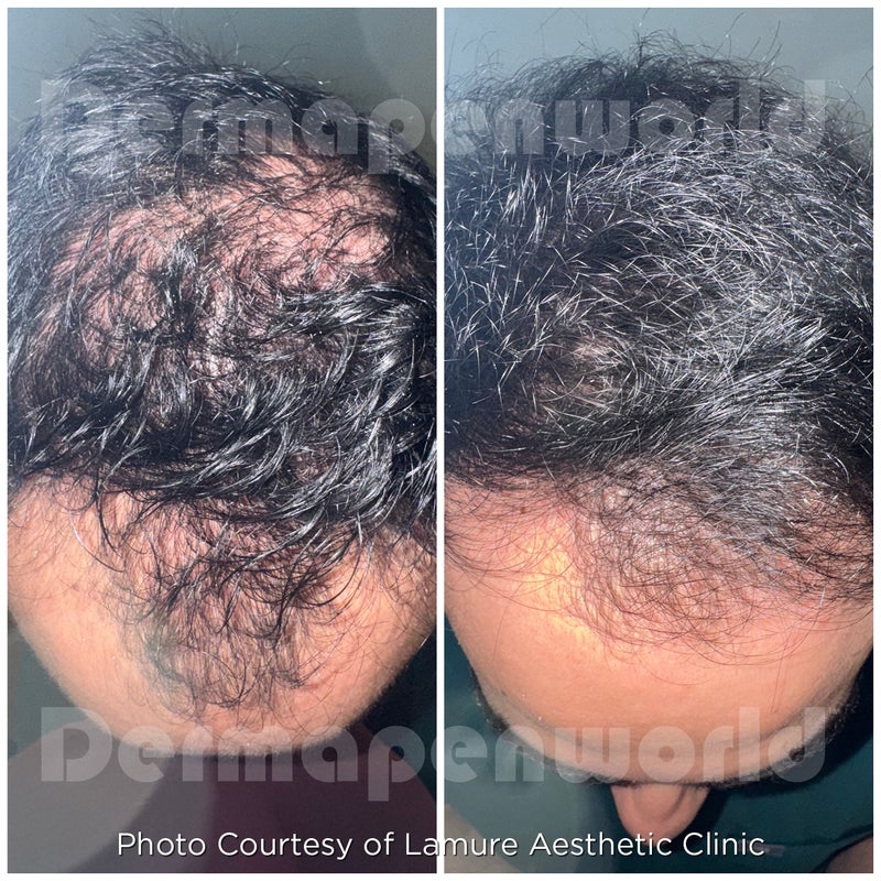 Hair restoration 3