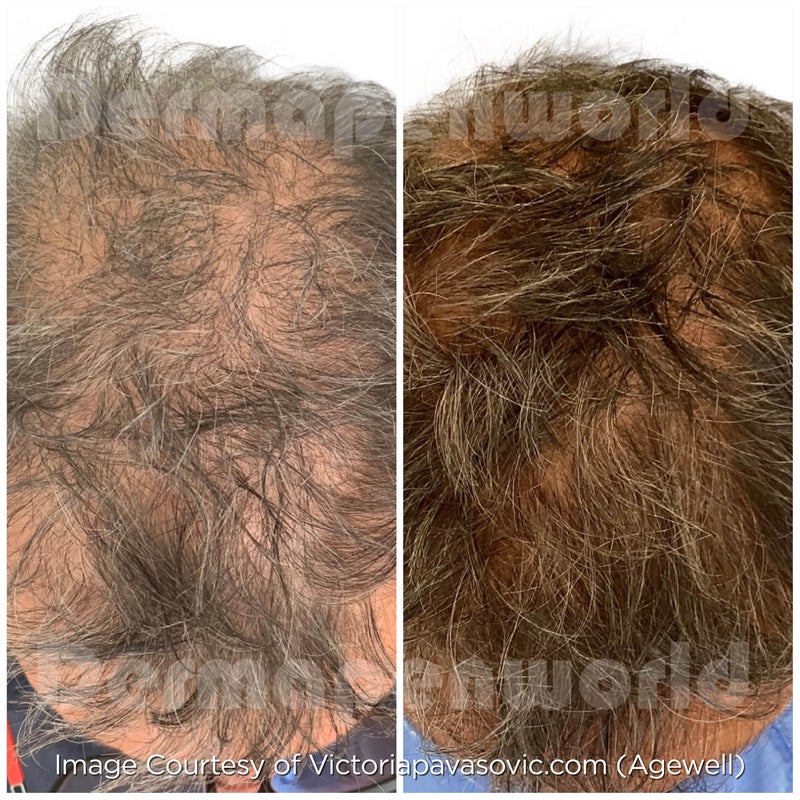 Hair restoration 4