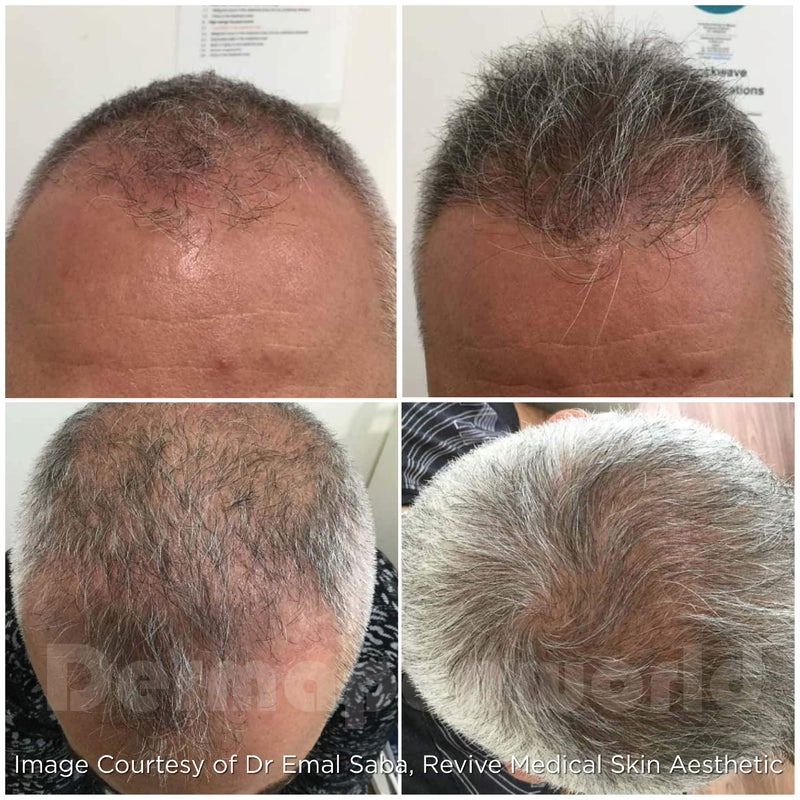 Hair restoration 6