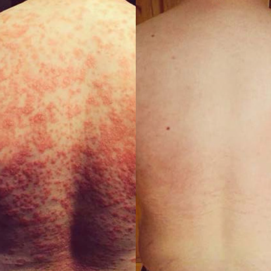 NIR--13-Tri-Wave-MD-Treatments--3-Weeks--Courtesy-of-Opium-Skin-and-Beauty--Tullamore