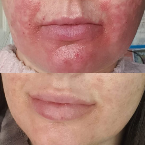 NIR--3-Tri-Wave-MD-Treatments--3-Weeks