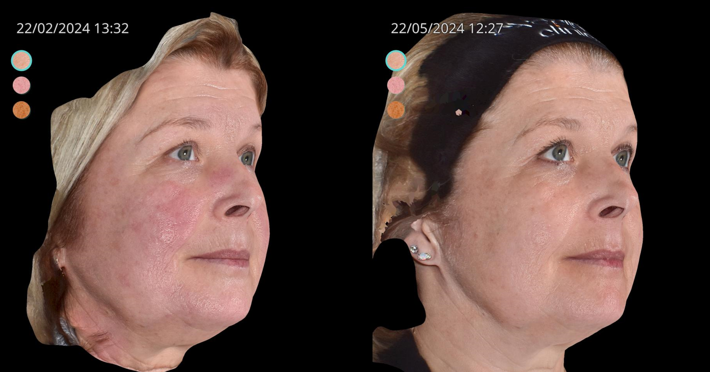 Red--NIR--6-Tri-Wave-MD-Treatments--3-Weeks--Courtesy-of-Dr-Ian-Strawford