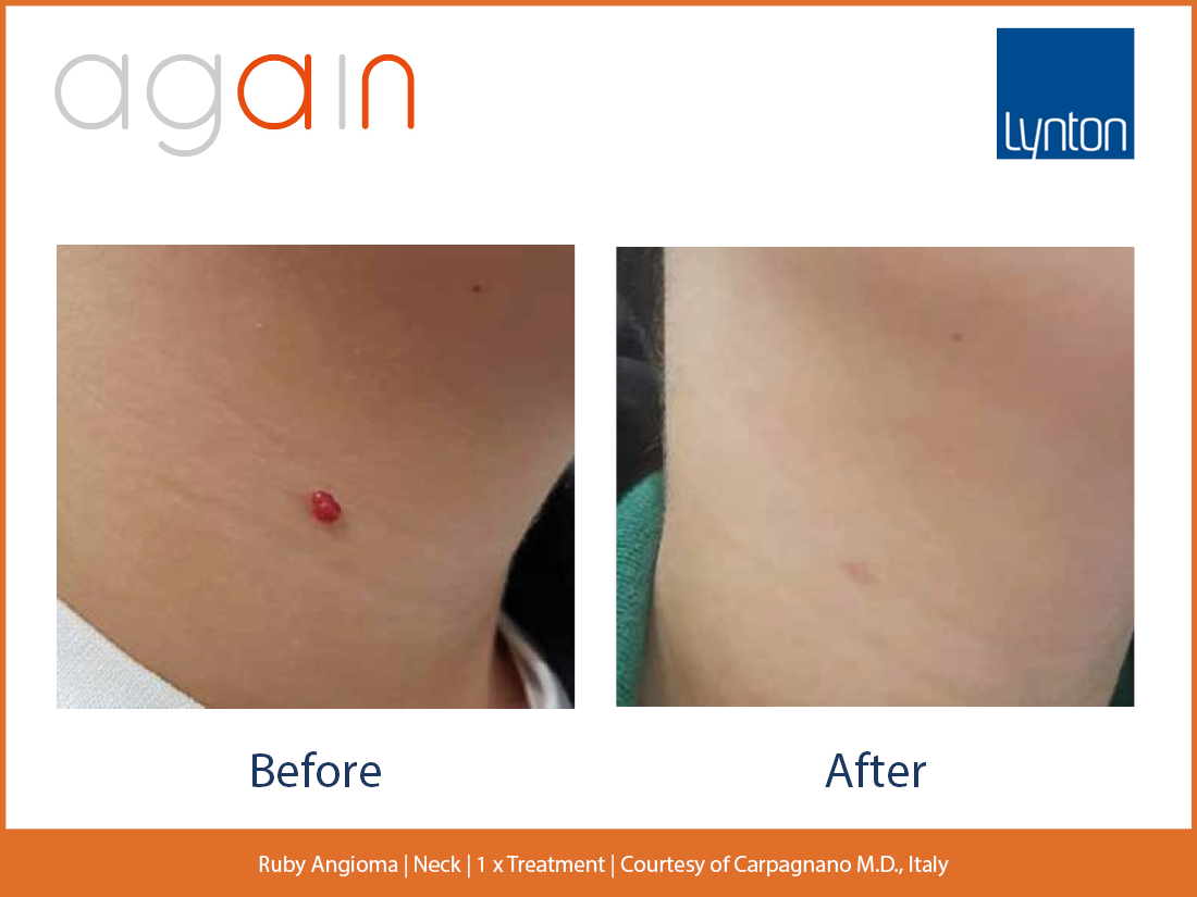 Ruby Angioma. Neck. Before and After. Again. Pro