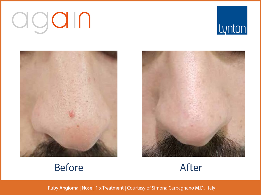 Ruby Angioma. Nose. Before and After. Again. Pro