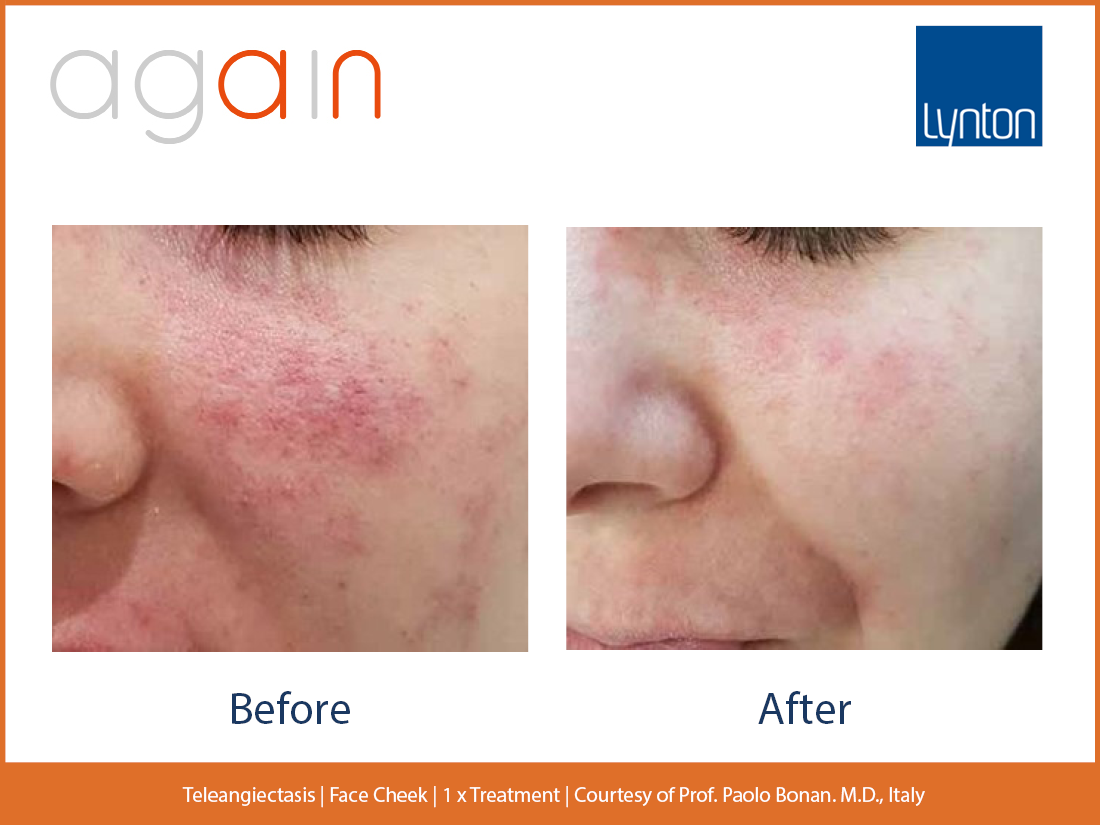 Teleangectasias. Face Cheek. 2. Before and After. Again. Pro