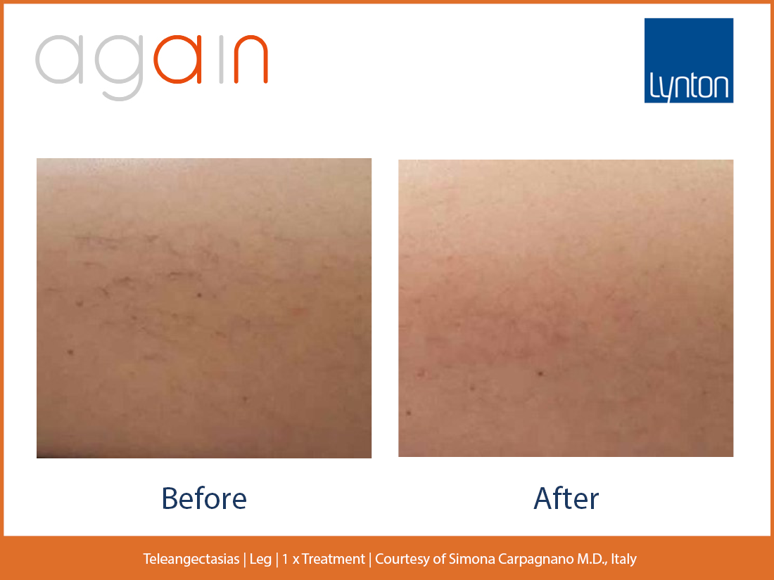 Teleangectasias. Leg. Before and After. Again. Pro