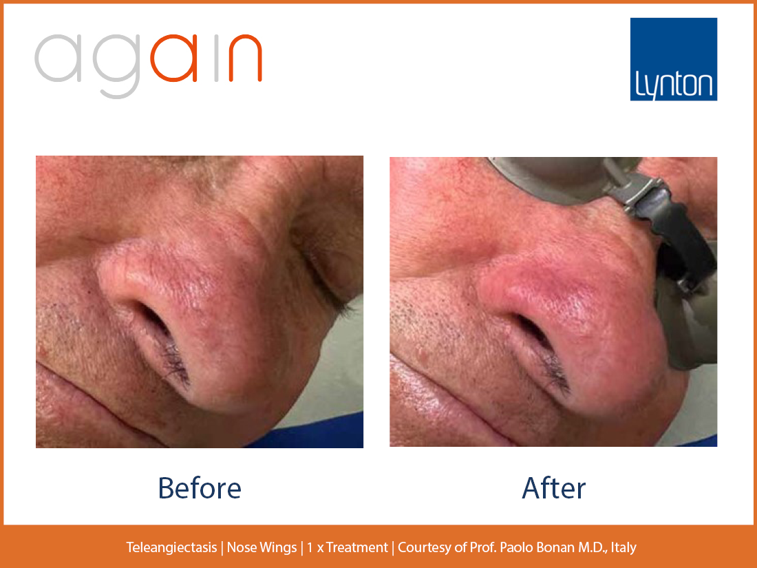 Teleangectasias. Nose Wings. 2. Before and After. Again. Pro