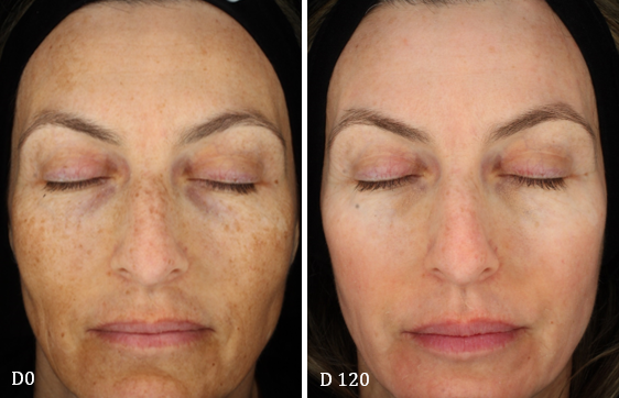 cosmelan-before-and-after-melasma-D120 (1)