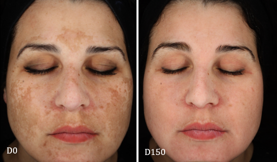 cosmelan-before-and-after-melasma-D150 (1)