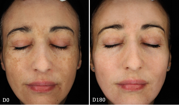 cosmelan-before-and-after-melasma-D180 (1)