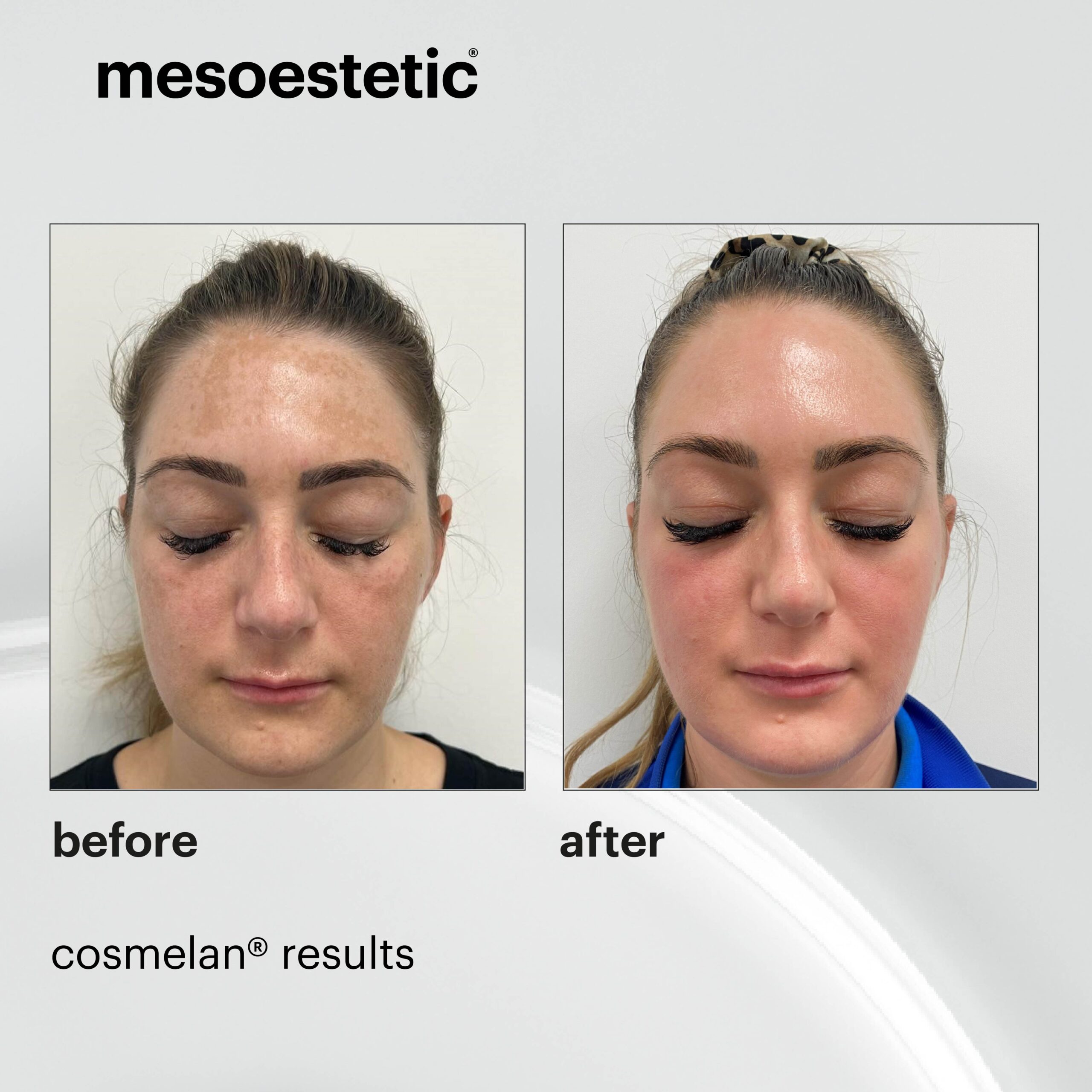 cosmelan_before-and-after-scaled (2)