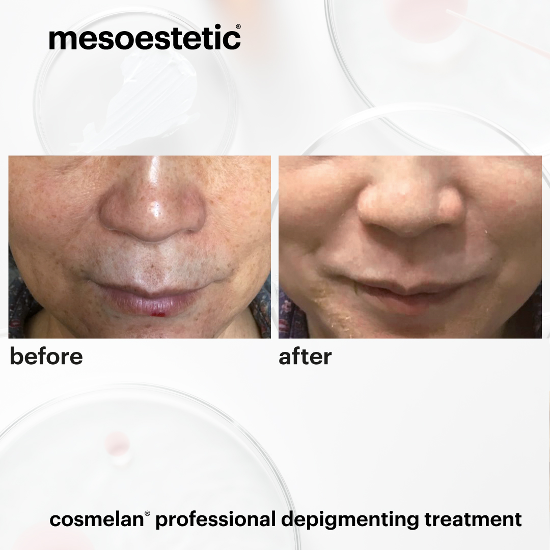 mesoestetic_cosmelan-before-and-after (1)