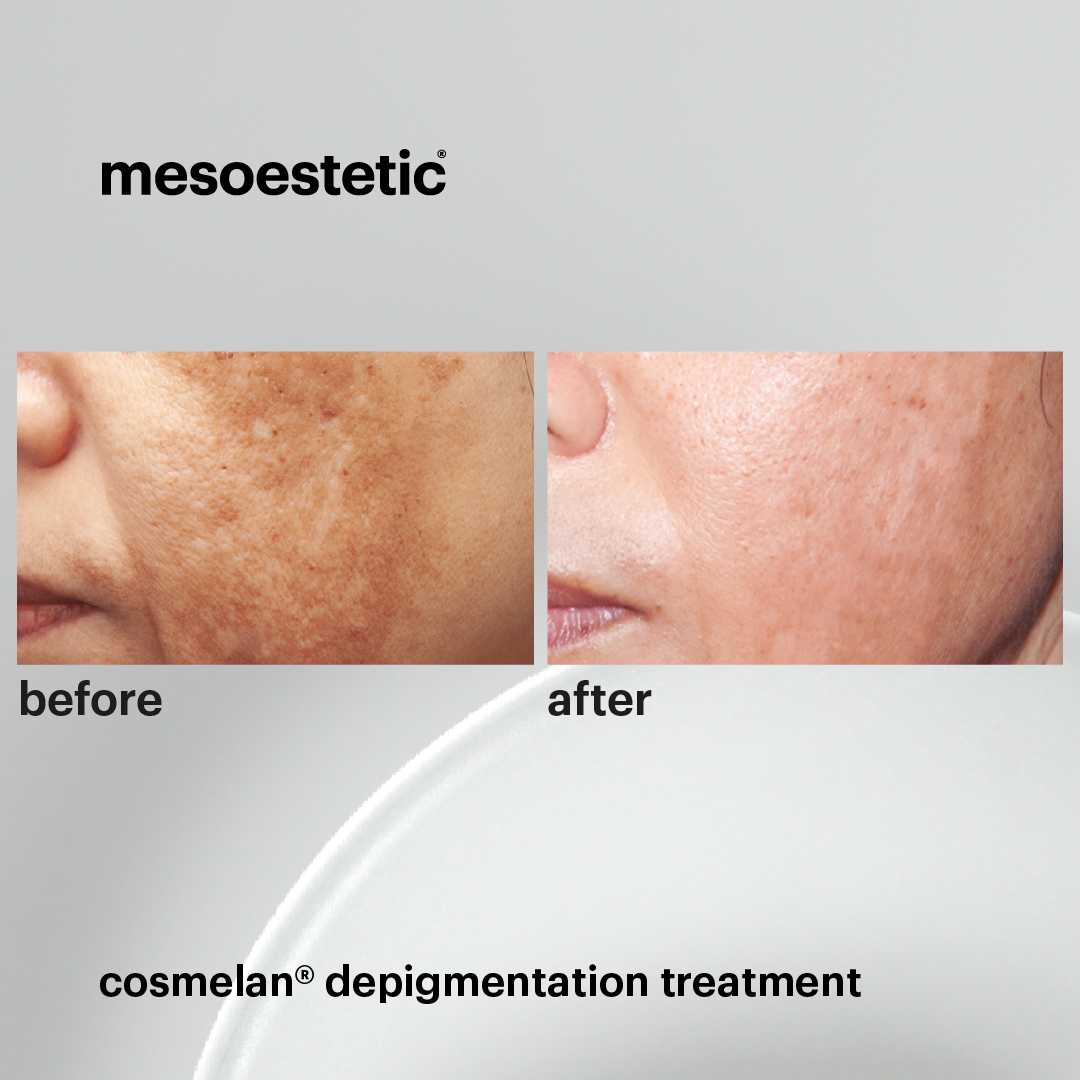 mesoestetic_cosmelan-before-and-after-2 (1)